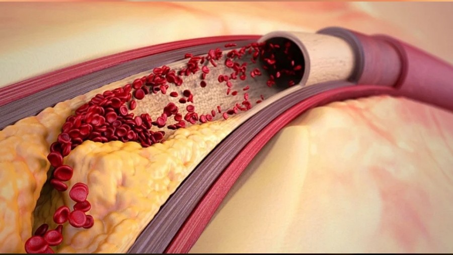 Sessiz tehlike: Damar sertli�i