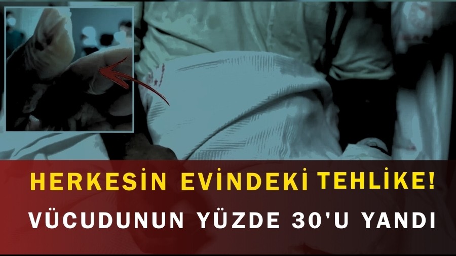Herkesin Evindeki Tehlike! V�cudunun Y�zde 30'u Yand�